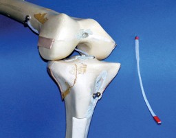A ligament for the knee – a 3D braided prefab
